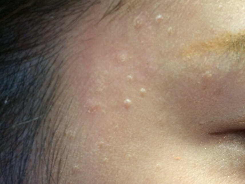 額に小さなぶつぶつができる原因